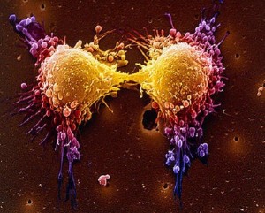 cancro-tumore-chemio-terapia-600x482